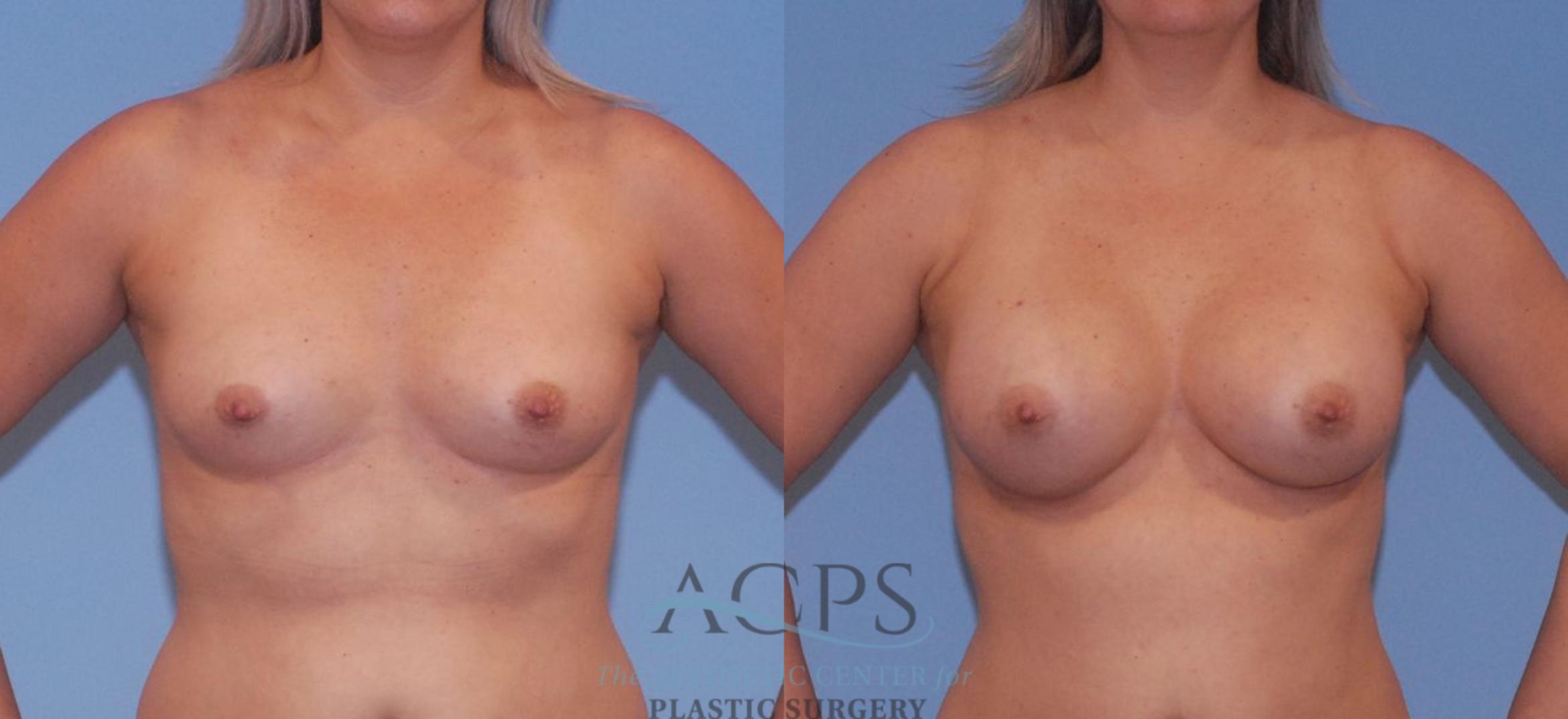 Before & After Breast Augmentation Case 805 Front View: View in Houston, TX