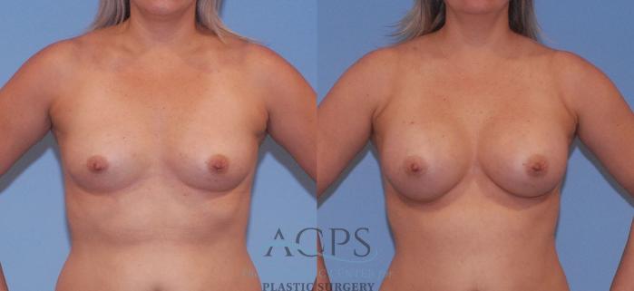 Before & After Breast Augmentation Case 805 Front View: View in Houston, TX