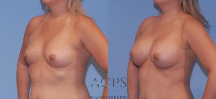 Before & After Breast Augmentation Case 805 Left Oblique View: View in Houston, TX