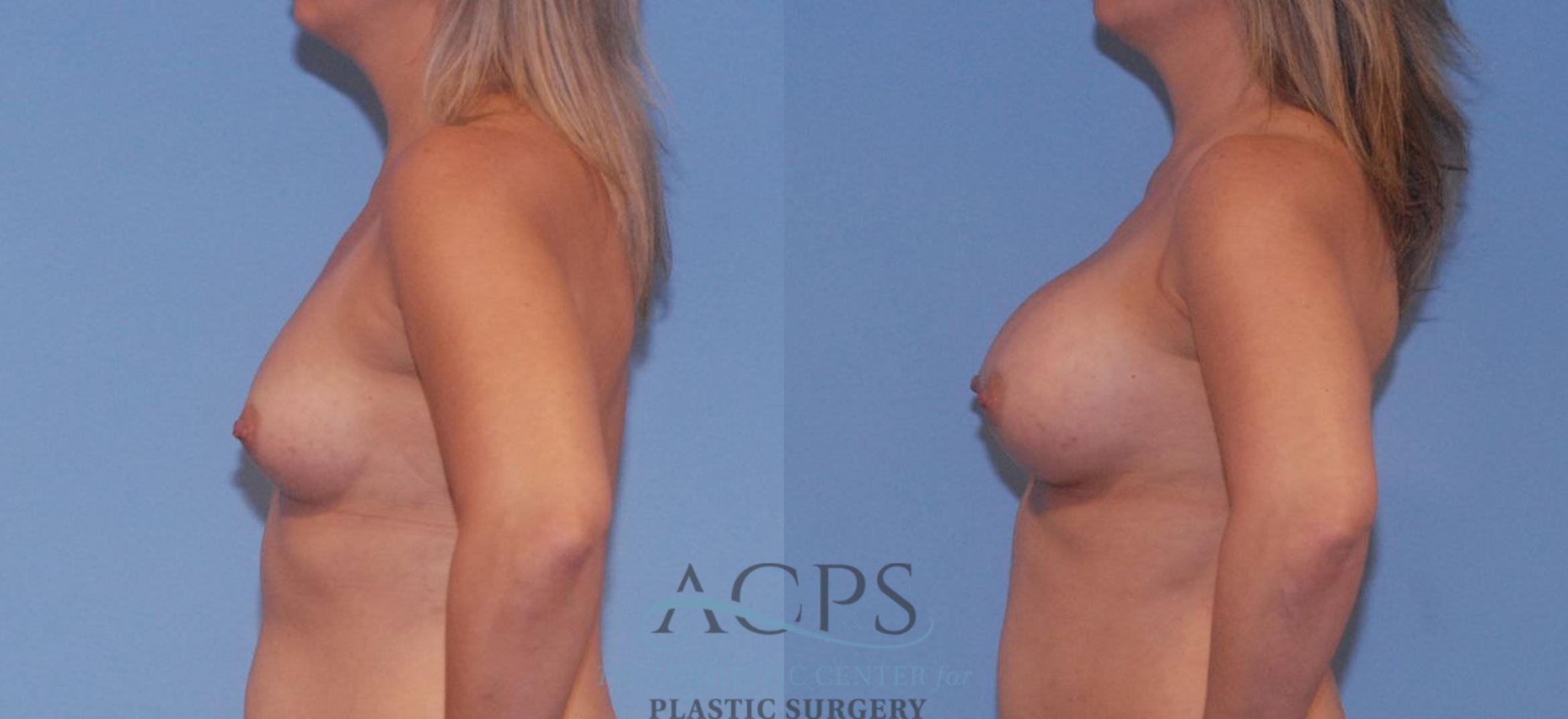 Before & After Breast Augmentation Case 805 Left Side View: View in Houston, TX