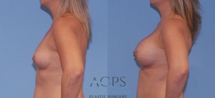 Before & After Breast Augmentation Case 805 Left Side View: View in Houston, TX