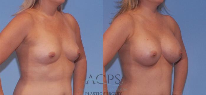 Before & After Breast Augmentation Case 805 Oblique View: View in Houston, TX