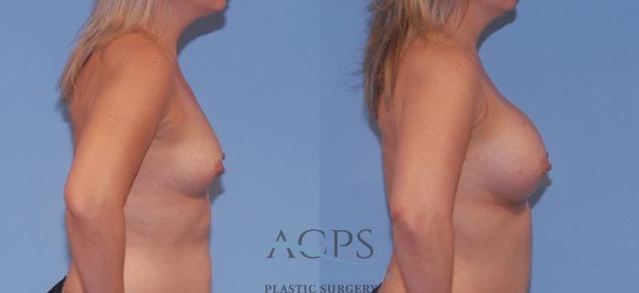 Before & After Breast Augmentation Case 805 Right Side View: View in Houston, TX