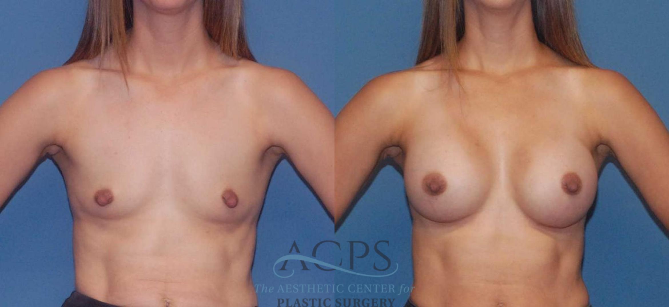 Before & After Breast Augmentation Case 806 Front View: View in Houston, TX