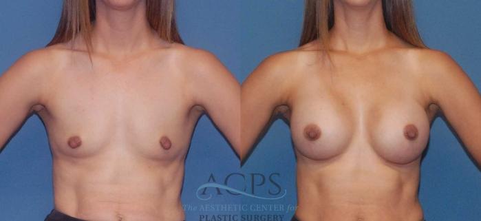 Before & After Breast Augmentation Case 806 Front View: View in Houston, TX