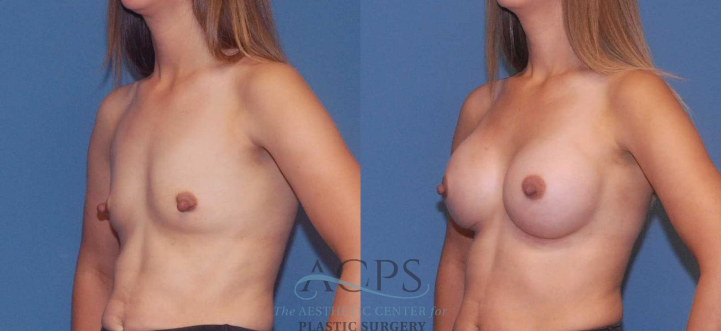 Before & After Breast Augmentation Case 806 Left Oblique View: View in Houston, TX