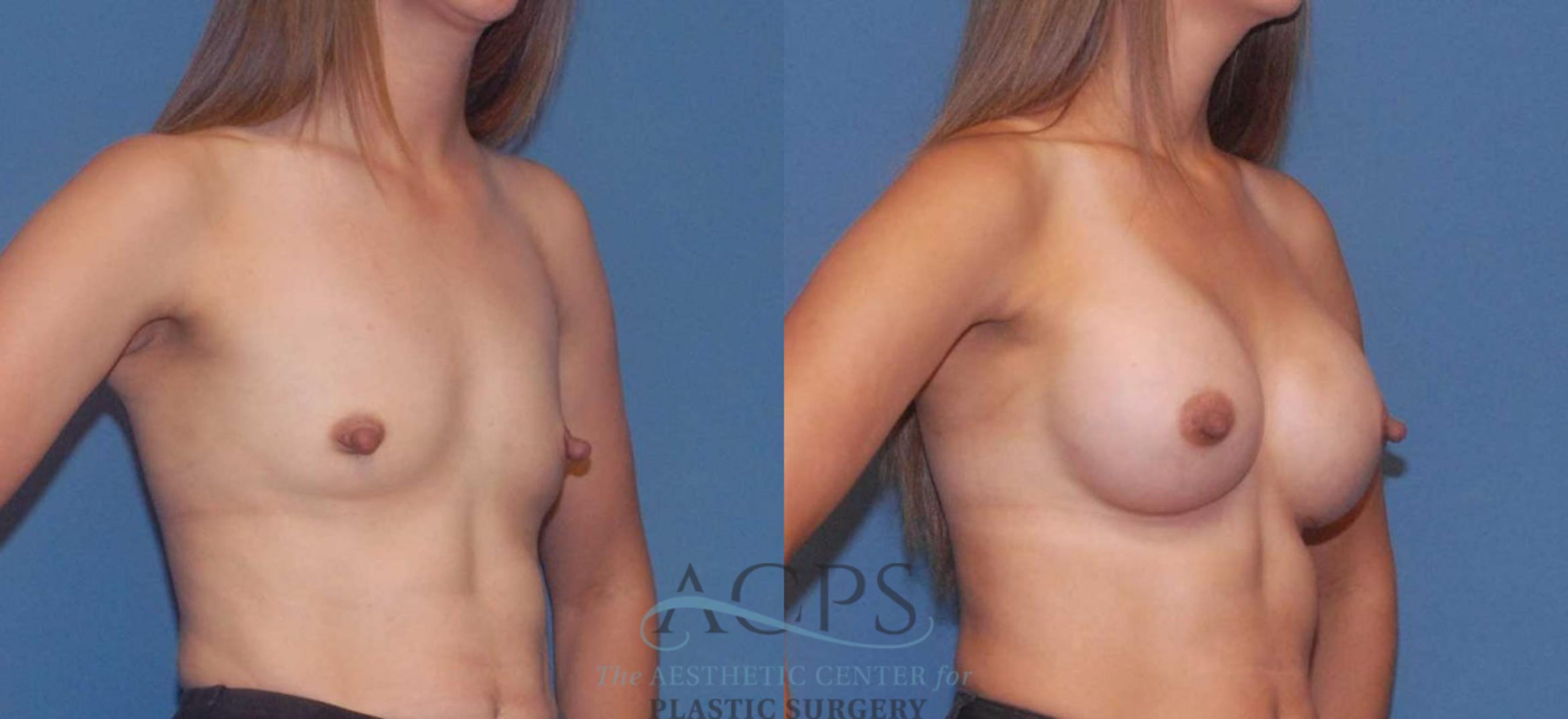 Before & After Breast Augmentation Case 806 Oblique View: View in Houston, TX