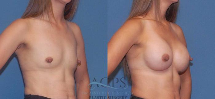 Before & After Breast Augmentation Case 806 Oblique View: View in Houston, TX