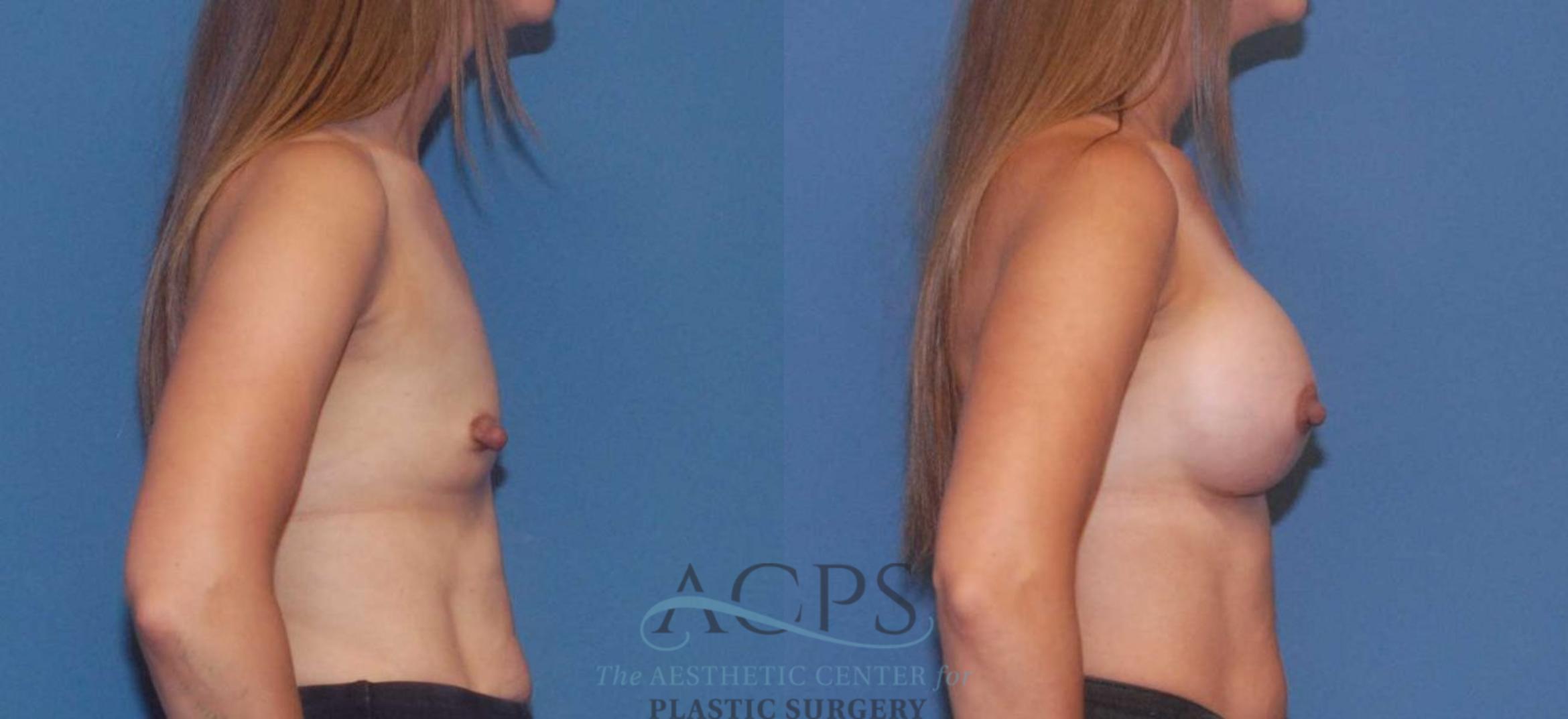 Before & After Breast Augmentation Case 806 Right Side View: View in Houston, TX