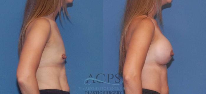 Before & After Breast Augmentation Case 806 Right Side View: View in Houston, TX
