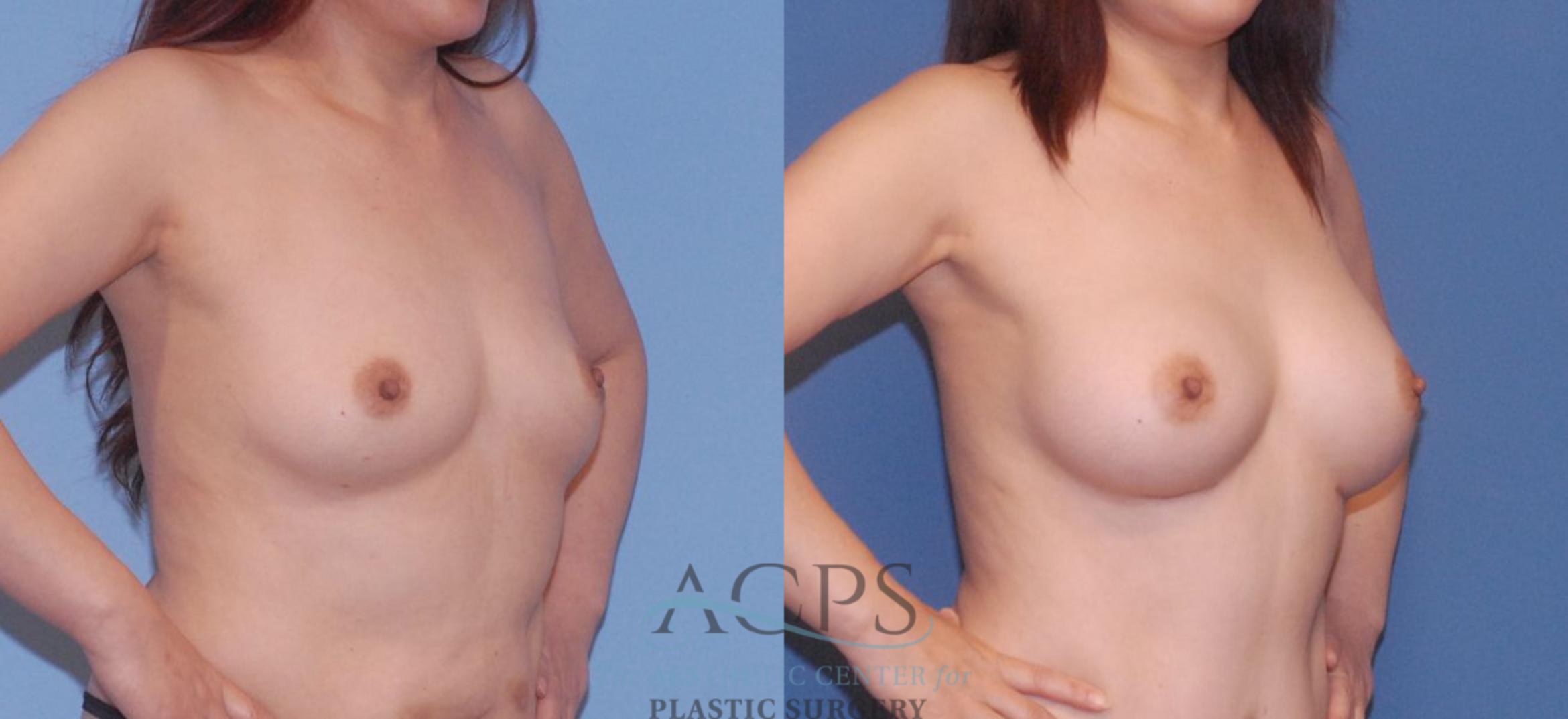 Before & After Breast Augmentation Case 807 Oblique View: View in Houston, TX
