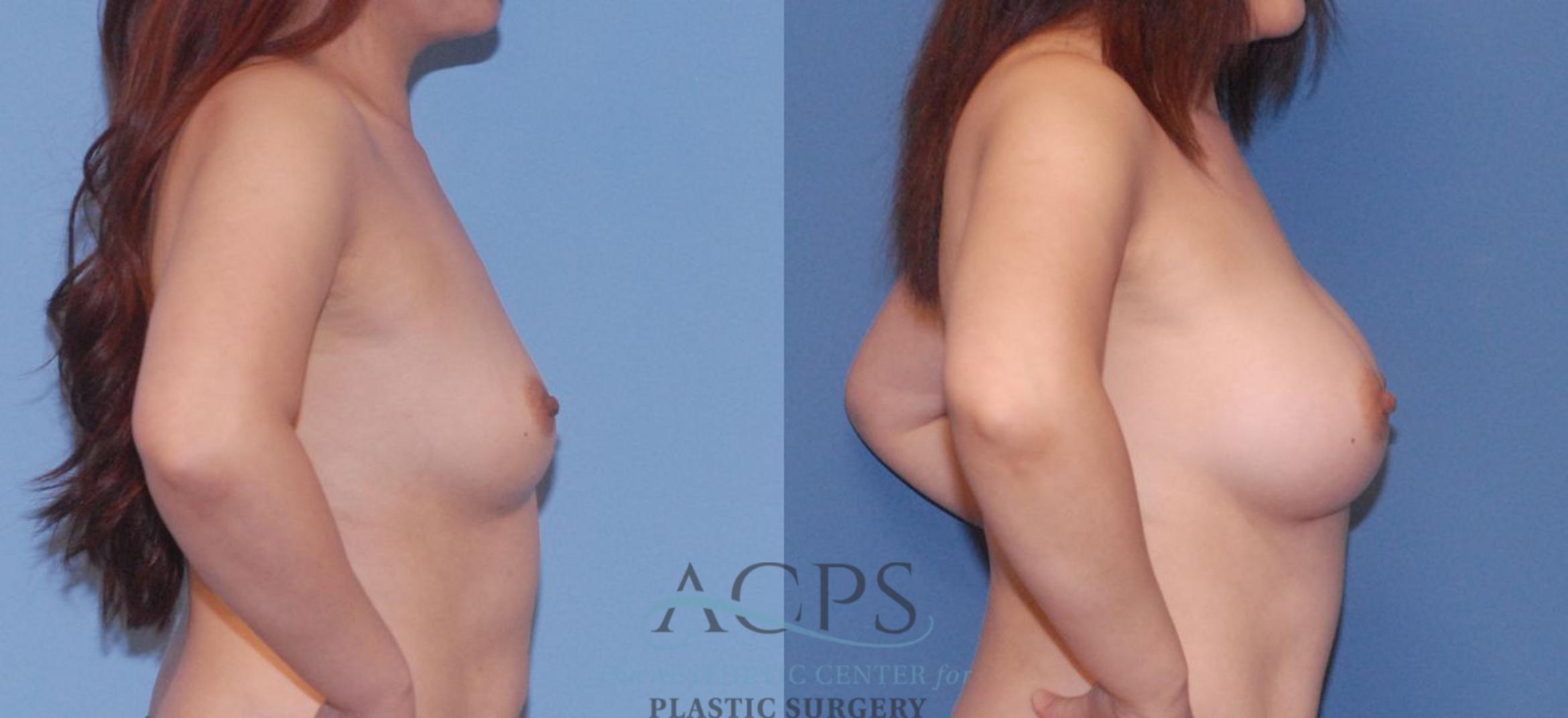 Before & After Breast Augmentation Case 807 Right Side View: View in Houston, TX