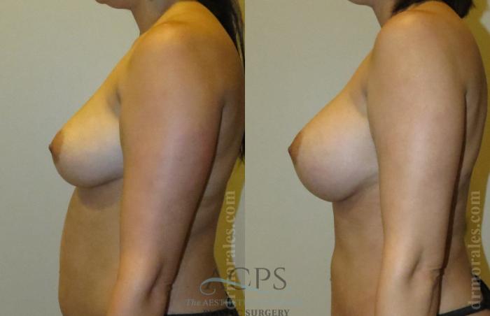 Before & After Breast Augmentation Case 808 Side View: View in Houston, TX
