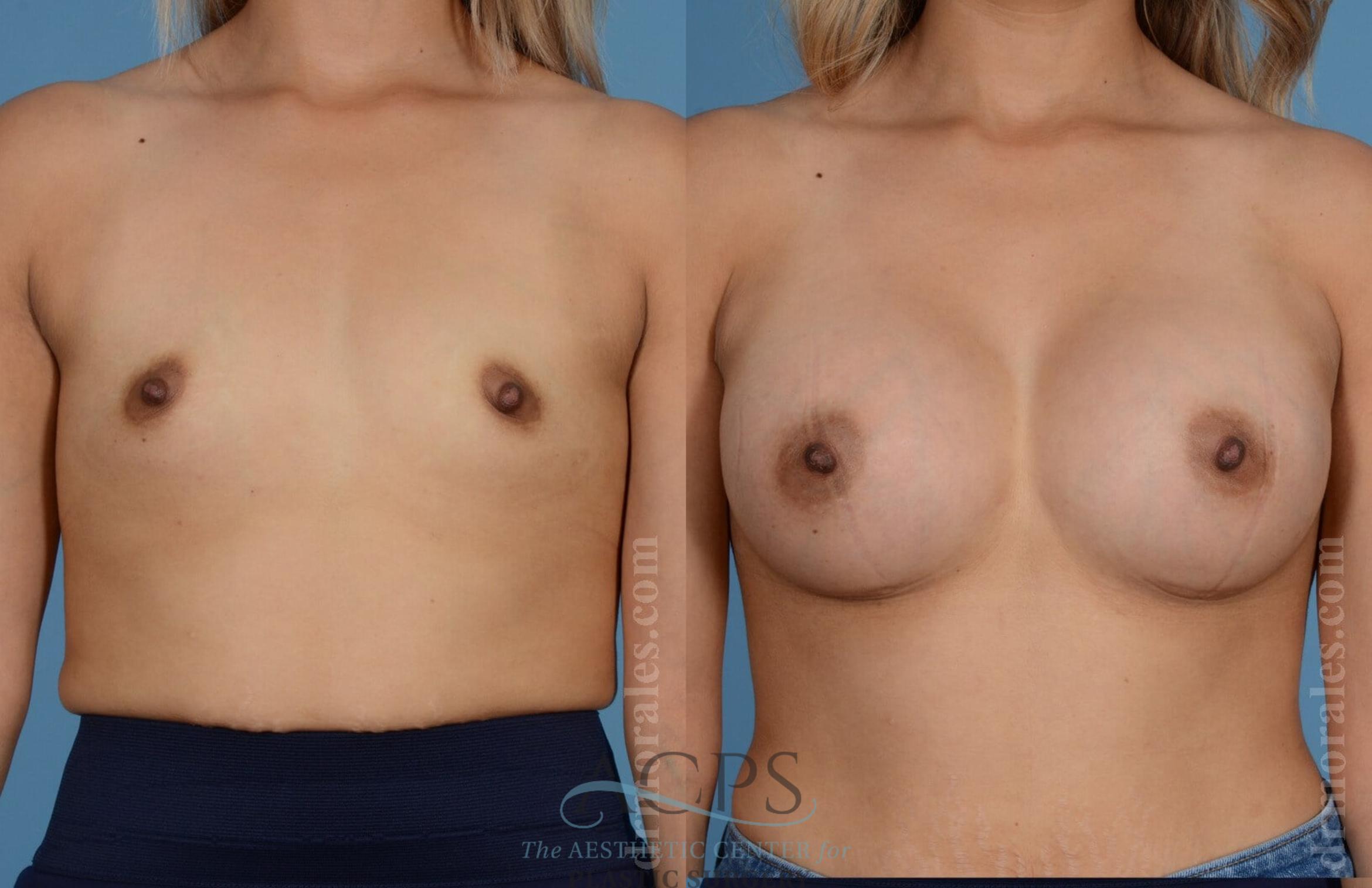 Before & After Breast Augmentation Case 809 Front View: View in Houston, TX