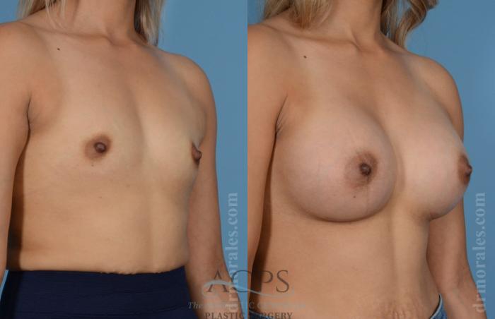 Before & After Breast Augmentation Case 809 Oblique View: View in Houston, TX