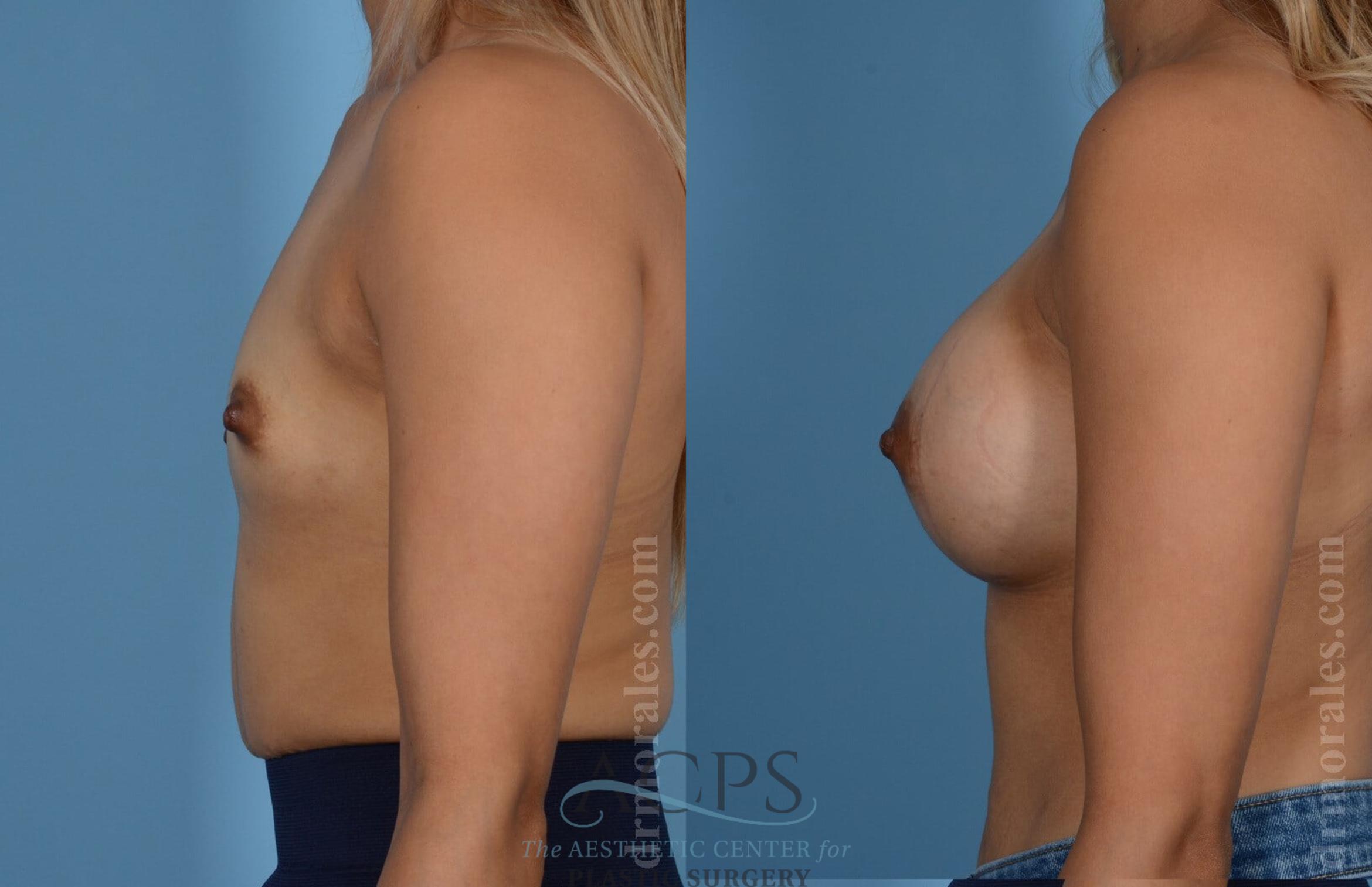 Before & After Breast Augmentation Case 809 Side View: View in Houston, TX