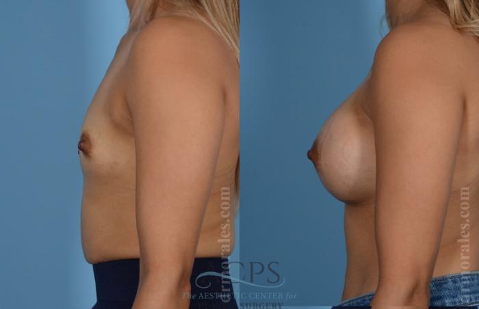 Before & After Breast Augmentation Case 809 Side View: View in Houston, TX