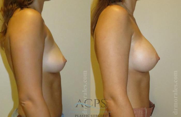 Before & After Breast Augmentation Case 810 Side View: View in Houston, TX