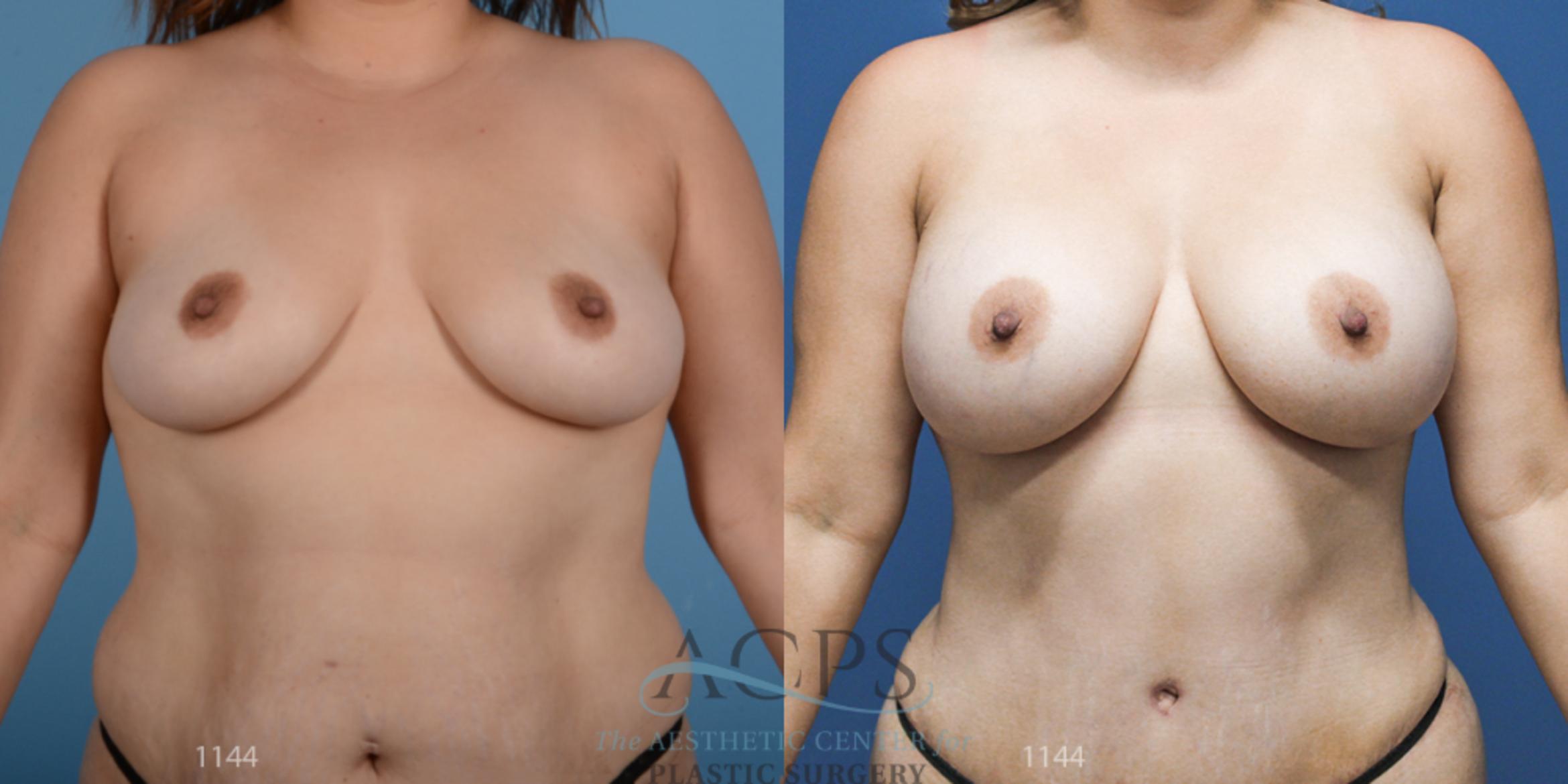 Before & After Breast Augmentation Case 811 Front View: View in Houston, TX