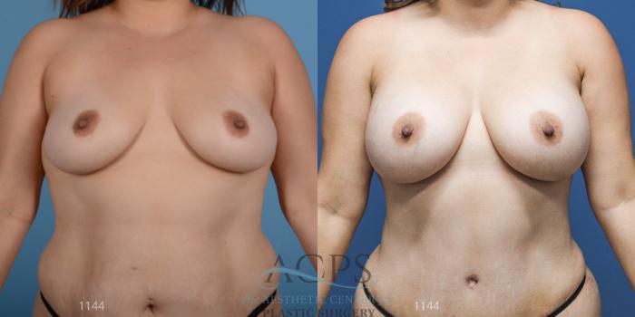 Before & After Breast Augmentation Case 811 Front View: View in Houston, TX