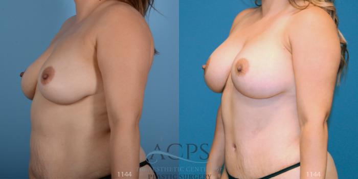 Before & After Breast Augmentation Case 811 Oblique View: View in Houston, TX