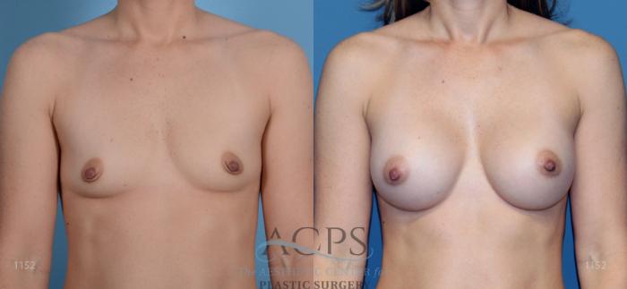 Before & After Breast Augmentation Case 812 Front View: View in Houston, TX