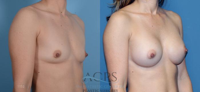 Before & After Breast Augmentation Case 812 Oblique View: View in Houston, TX