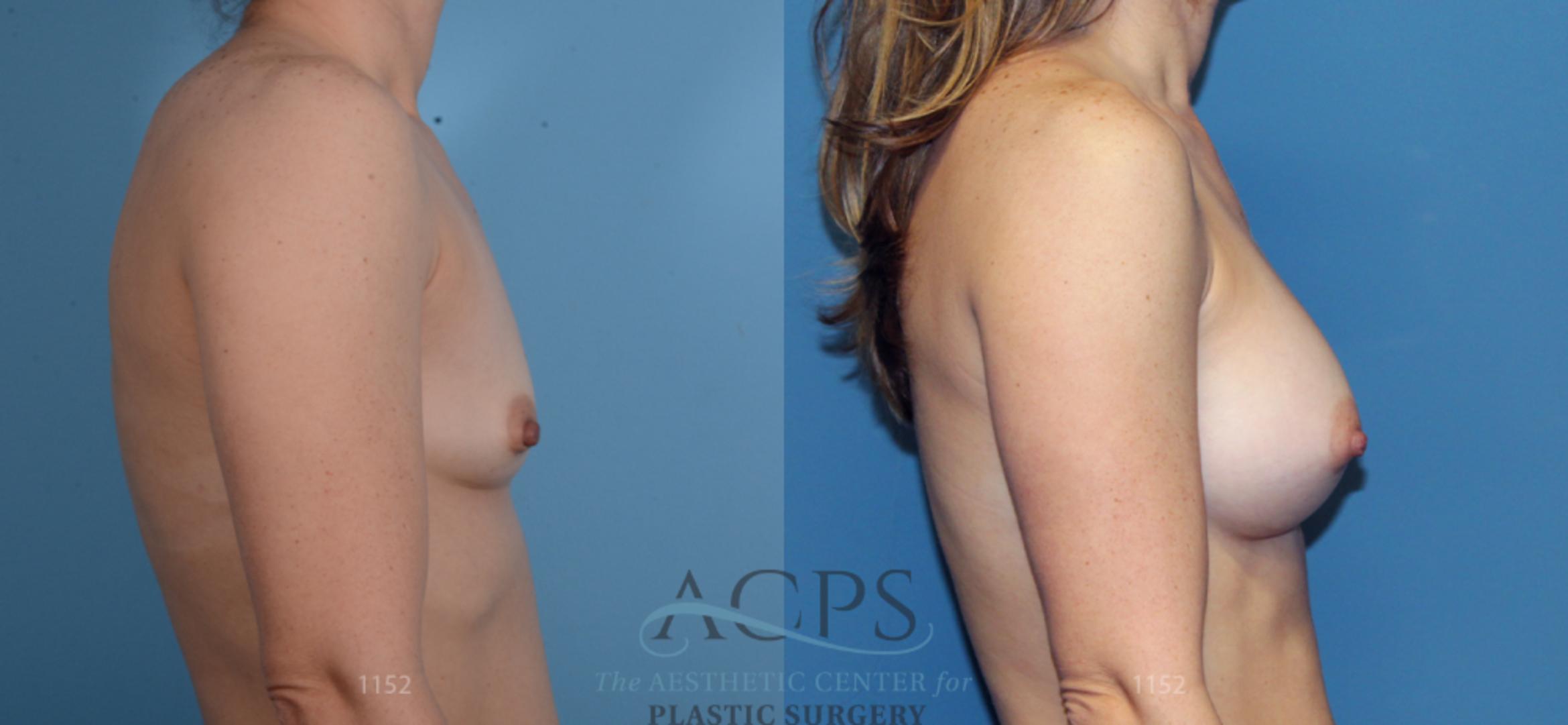 Before & After Breast Augmentation Case 812 Side View: View in Houston, TX