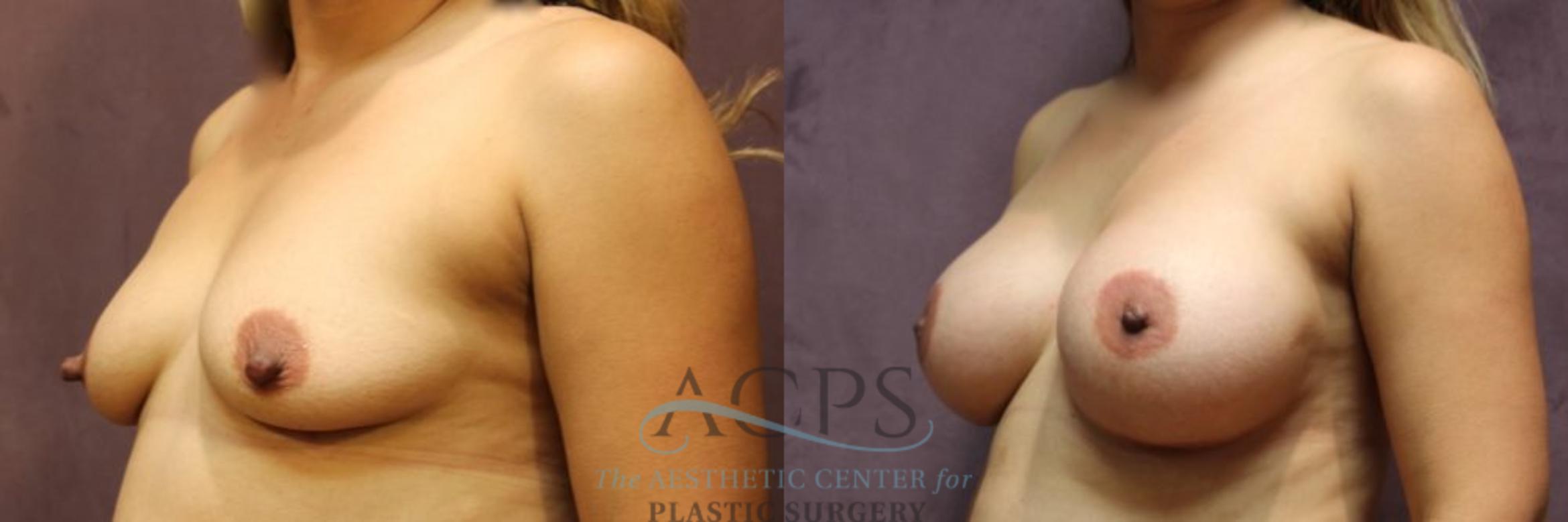 Before & After Breast Augmentation Case 813 Oblique View: View in Houston, TX