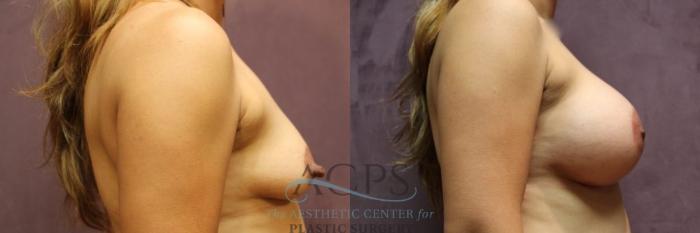 Before & After Breast Augmentation Case 813 Side View: View in Houston, TX