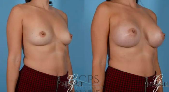 Before & After Breast Augmentation Case 814 Oblique View: View in Houston, TX