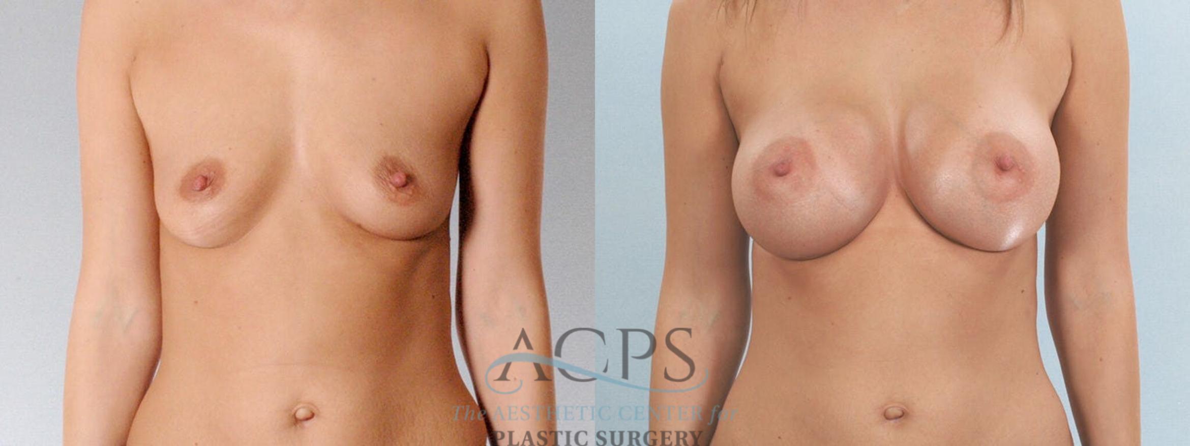Before & After Breast Augmentation Case 816 Front View: View in Houston, TX