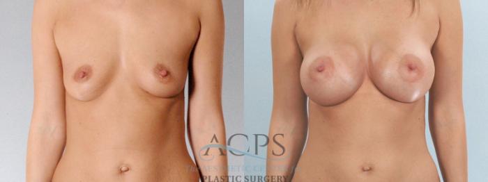 Before & After Breast Augmentation Case 816 Front View: View in Houston, TX