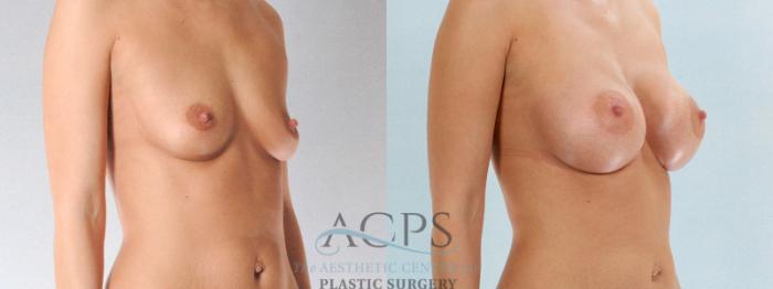 Before & After Breast Augmentation Case 816 Oblique View: View in Houston, TX