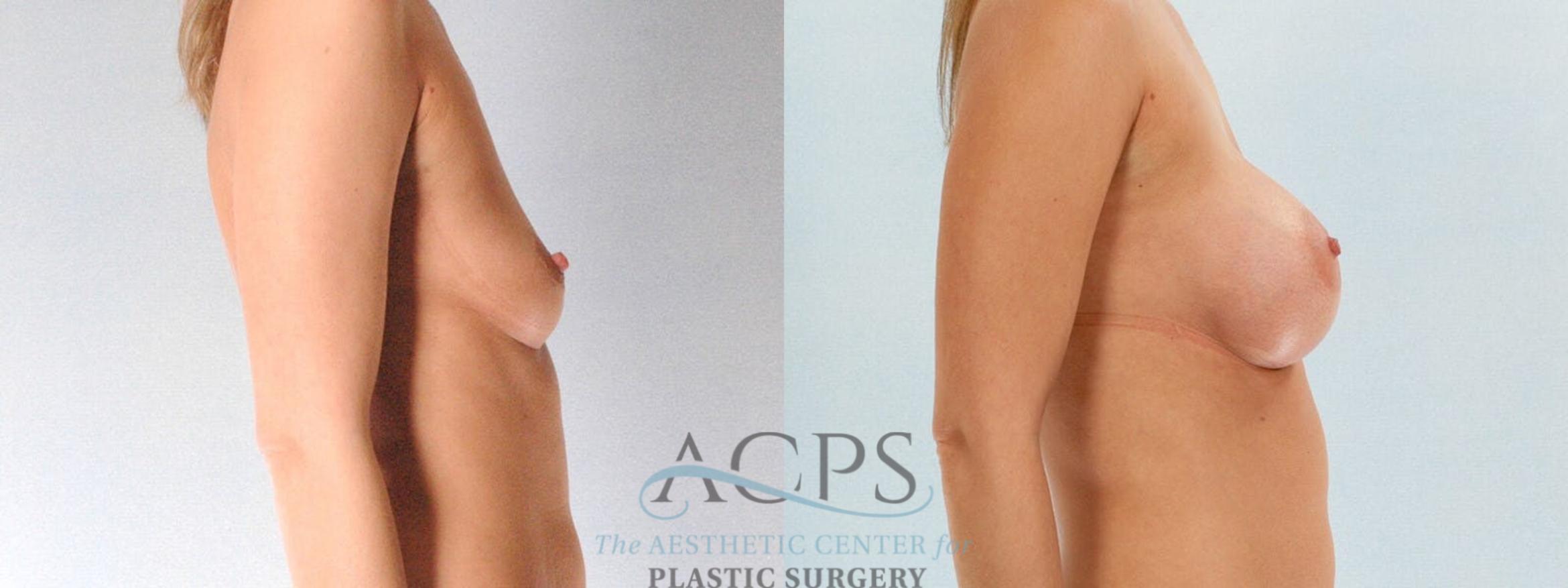 Before & After Breast Augmentation Case 816 Side View: View in Houston, TX