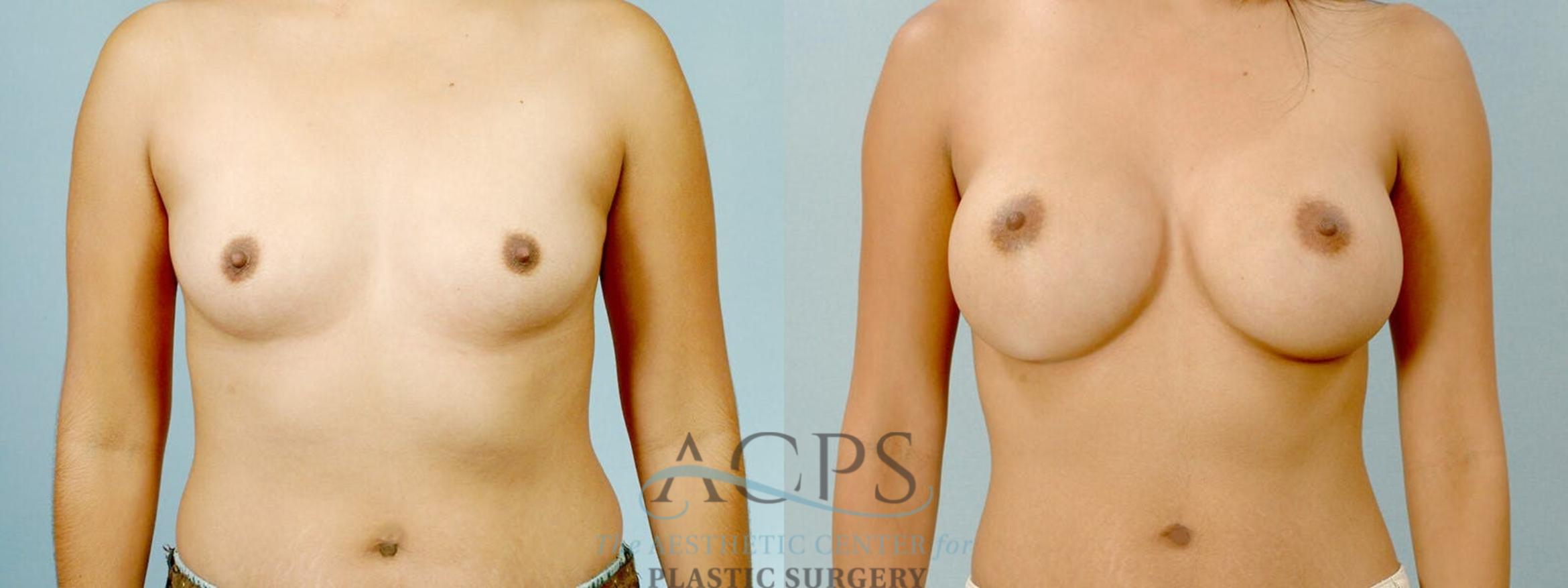 Before & After Breast Augmentation Case 817 Front View: View in Houston, TX