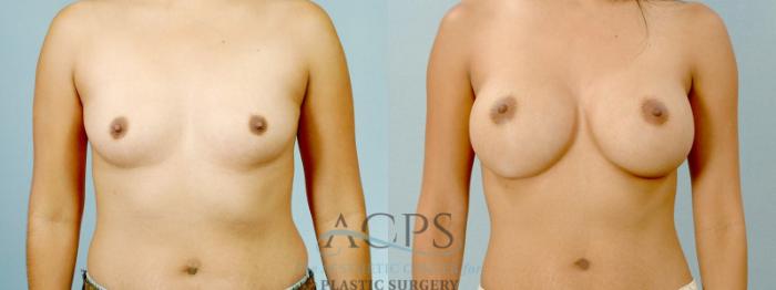 Before & After Breast Augmentation Case 817 Front View: View in Houston, TX