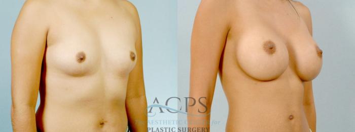 Before & After Breast Augmentation Case 817 Oblique View: View in Houston, TX