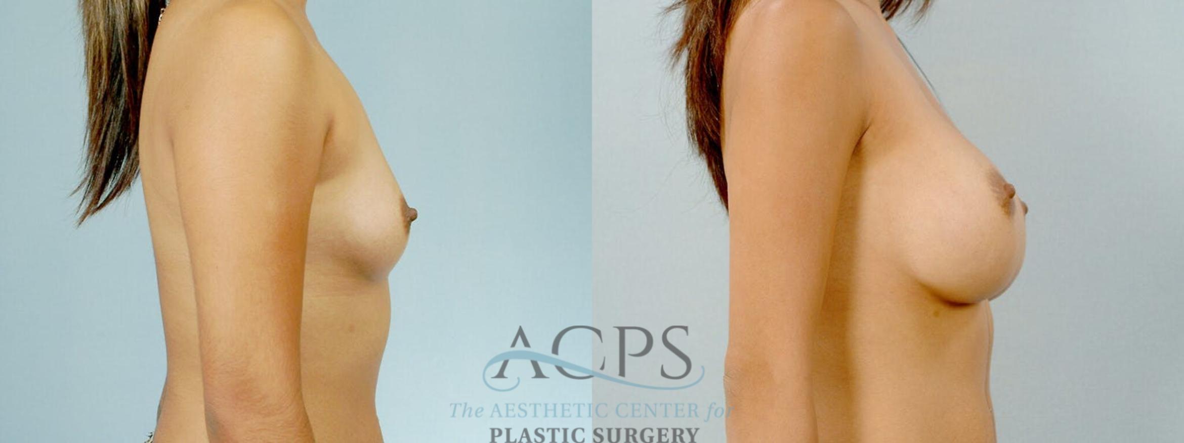 Before & After Breast Augmentation Case 817 Side View: View in Houston, TX