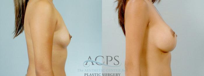 Before & After Breast Augmentation Case 817 Side View: View in Houston, TX