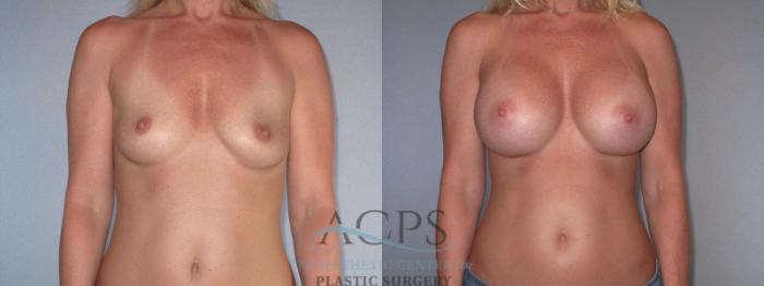 Before & After Breast Augmentation Case 818 Front View: View in Houston, TX