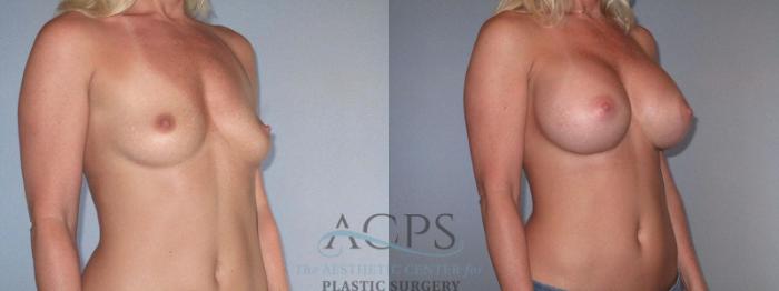 Before & After Breast Augmentation Case 818 Oblique View: View in Houston, TX