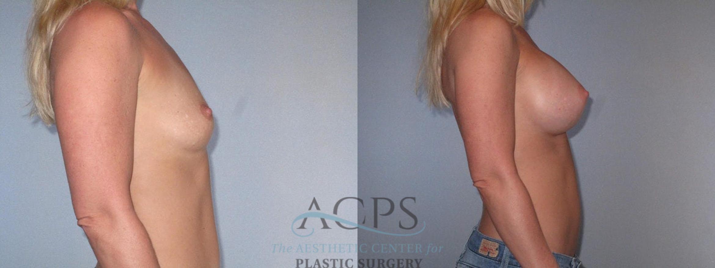Before & After Breast Augmentation Case 818 Side View: View in Houston, TX