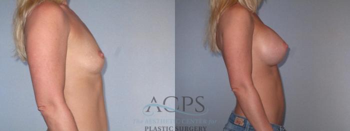 Before & After Breast Augmentation Case 818 Side View: View in Houston, TX