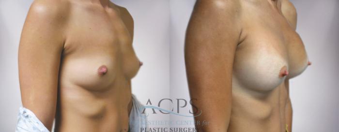Before & After Breast Augmentation Case 819 Oblique Right View: View in Houston, TX