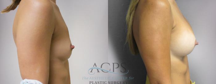 Before & After Breast Augmentation Case 819 Side Right View: View in Houston, TX