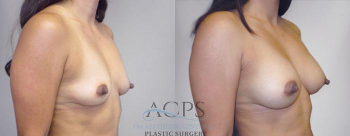 Before & After Breast Augmentation Case 820 Oblique Right View: View in Houston, TX