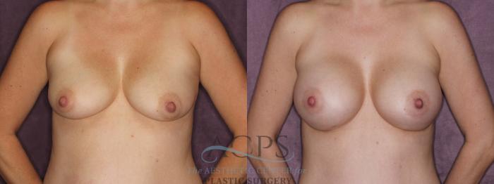 Before & After Breast Augmentation Case 821 Front View: View in Houston, TX
