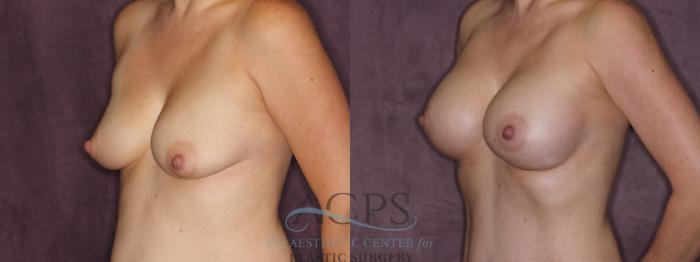 Before & After Breast Augmentation Case 821 Oblique Left View: View in Houston, TX