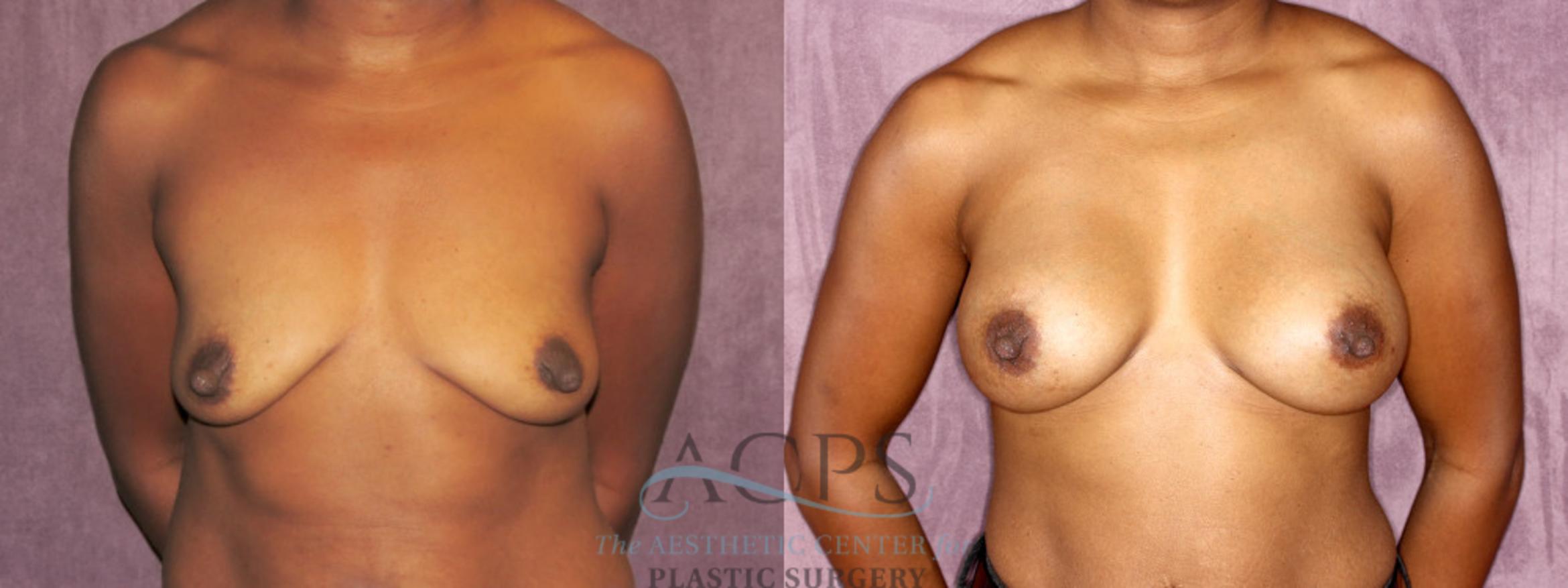 Before & After Breast Augmentation Case 822 Front View: View in Houston, TX